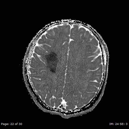 Balo concentric sclerosis (Radiopaedia 61637-69636 I 136).jpg