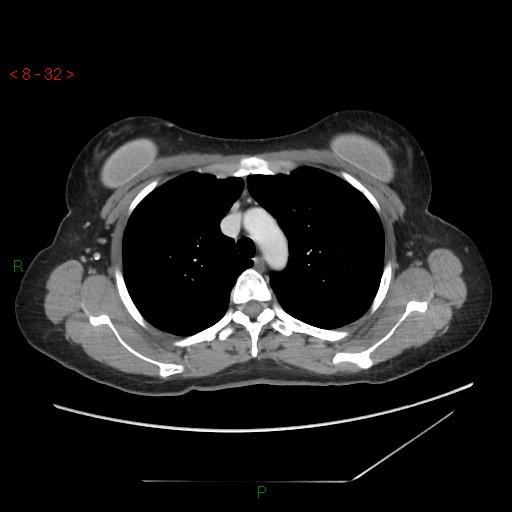 Bartholin gland cyst (Radiopaedia 54904-61181 A 8).jpg