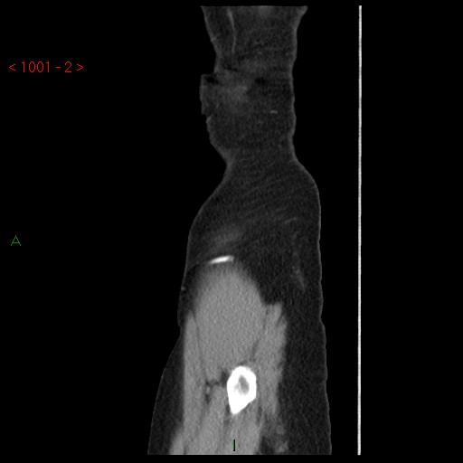 File:Bartholin gland cyst (Radiopaedia 54904-61181 Sagittal C+ delayed 2).jpg