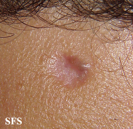 Basal Cell Carcinoma (Dermatology Atlas 145).jpg