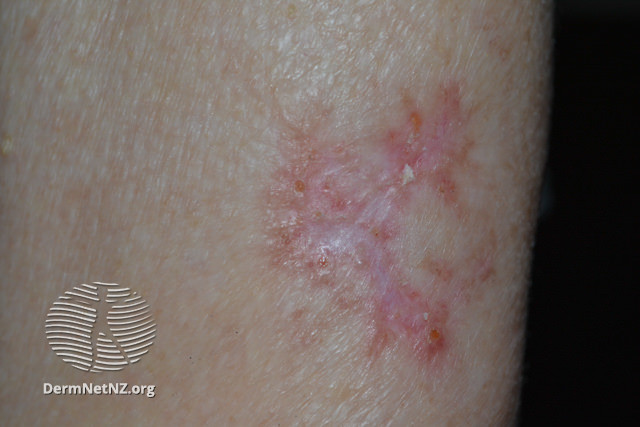 File:Basal cell carcinoma, arm (DermNet NZ bcc-arm-16-dn).jpg