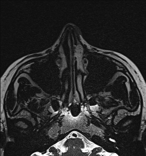 Basal cell carcinoma - nasal region (Radiopaedia 70292-80365 Axial Gradient Echo 26).jpg