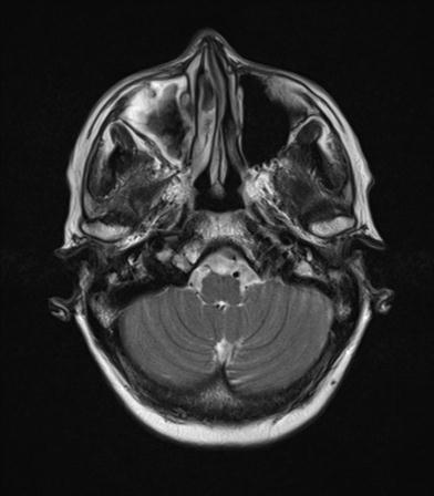 File:Base of skull chondrosarcoma (Radiopaedia 30410-31070 Axial T2 4).jpg