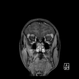 File:Base of skull rhabdomyosarcoma (Radiopaedia 32196-33142 I 21).jpg