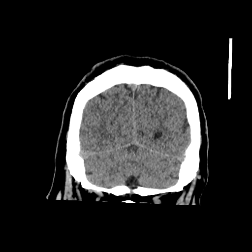 Basilar and bilateral vertebral artery occlusion (Radiopaedia 45592-49723 Coronal 53).png