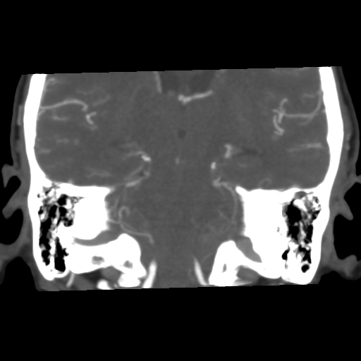 File:Basilar artery fenestration and aneurysms with subarachnoid hemorrhage (Radiopaedia 40066-42573 B 32).png