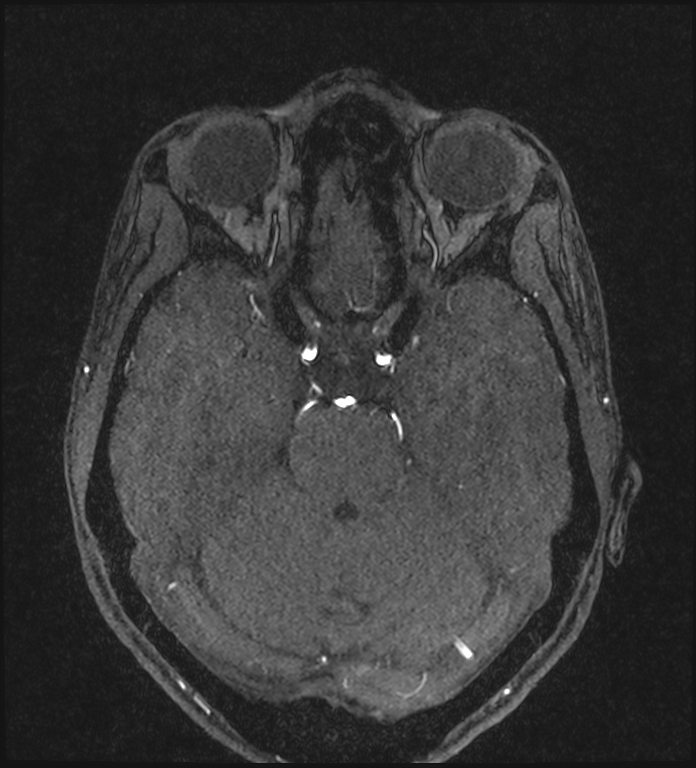 Basilar artery perforator aneurysm (Radiopaedia 82455-97733 Axial MRA 91).jpg