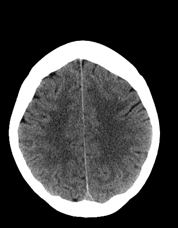 File:Basilar tip aneurysm with coiling (Radiopaedia 53912-60033 Axial non-contrast 20).jpg