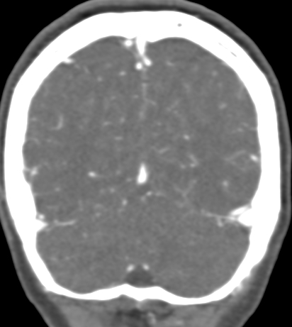 Basilar tip aneurysm with coiling (Radiopaedia 53912-60086 B 129).jpg