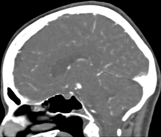 Basilar tip aneurysm with coiling (Radiopaedia 53912-60086 C 60).jpg