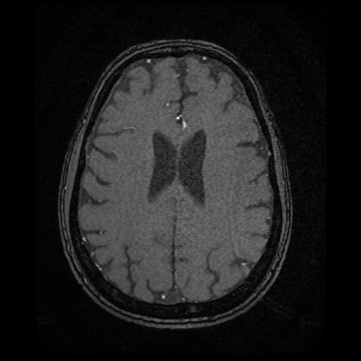 Basilar top and left middle cerebral artery aneurysm (Radiopaedia 61965-70031 Axial MRA 115).jpg
