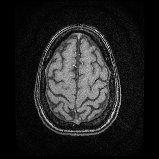 Basilar top and left middle cerebral artery aneurysm (Radiopaedia 61965-70031 Axial MRA 148).jpg