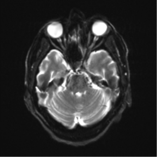 File:Behavioral variant frontotemporal dementia and late onset schizophrenia (Radiopaedia 52197-58083 Axial DTI Trace W 8).png