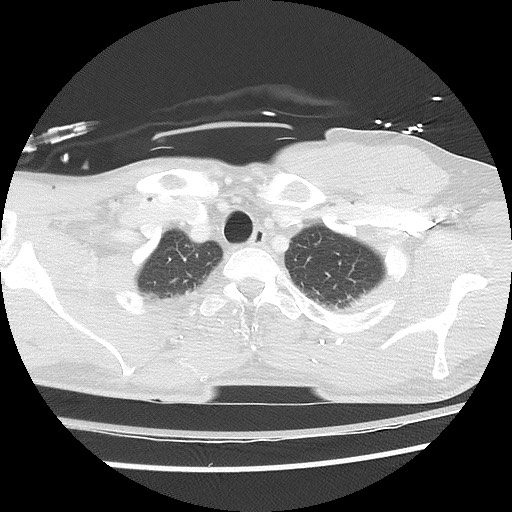 Benign post-traumatic pseudopneumoperitoneum (Radiopaedia 71199-81495 Axial lung window 17).jpg