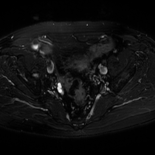 File:Benign prostatic nodular hyperplasia (Radiopaedia 16917-16634 Axial T2 fat sat 2).jpg