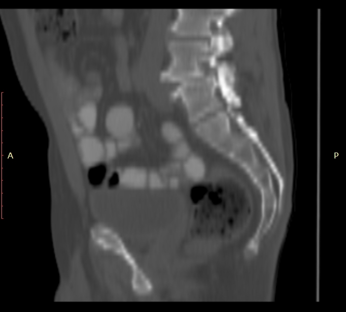 Bertolotti syndrome (Radiopaedia 58974-66235 Sagittal bone window 18).jpg