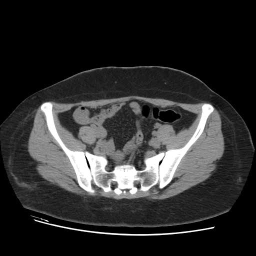 File:Bicornuate uterus- on MRI (Radiopaedia 49206-54296 Axial non-contrast 4).jpg