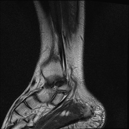 File:Bilateral Achilles tendon complete tear (Radiopaedia 81344-95051 Sagittal T2 18).jpg