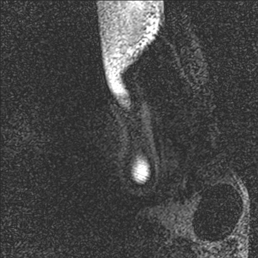 Bilateral Achilles tendon complete tear (Radiopaedia 81344-95051 Sagittal WE - Right 3).jpg