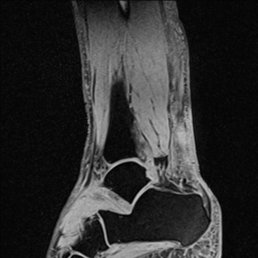 Bilateral Achilles tendon complete tear (Radiopaedia 81344-95051 Sagittal WE - Right 41).jpg