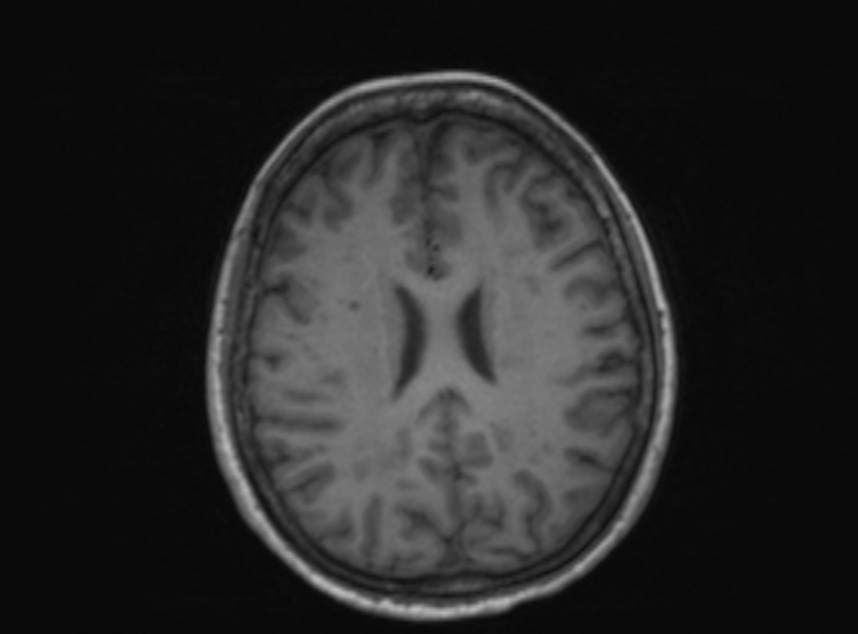Bilateral PCA territory infarction - different ages (Radiopaedia 46200-51784 Axial T1 201).jpg