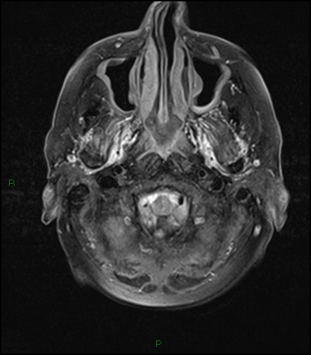 File:Bilateral acute middle cerebral artery territory infarcts (Radiopaedia 77319-89402 Axial FLAIR 3).jpg