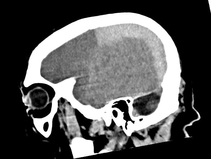 Bilateral acute on chronic subdural hematomas (Radiopaedia 78466-91146 C 45).jpg