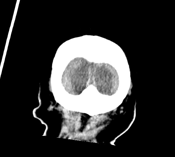 Bilateral acute on chronic subdural hematomas (Radiopaedia 78466-91146 Coronal non-contrast 64).jpg