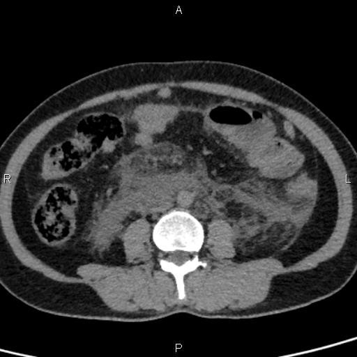 Bilateral adrenal gland hyperenhancement in pancreatitis (Radiopaedia 86642-102753 Axial non-contrast 64).jpg