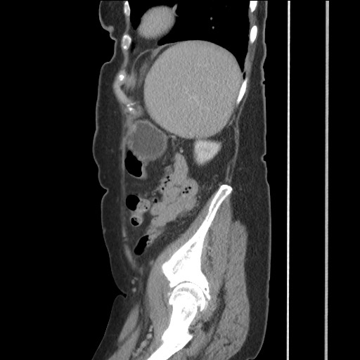 Bilateral adrenal granulocytic sarcomas (chloromas) (Radiopaedia 78375-91007 C 109).jpg