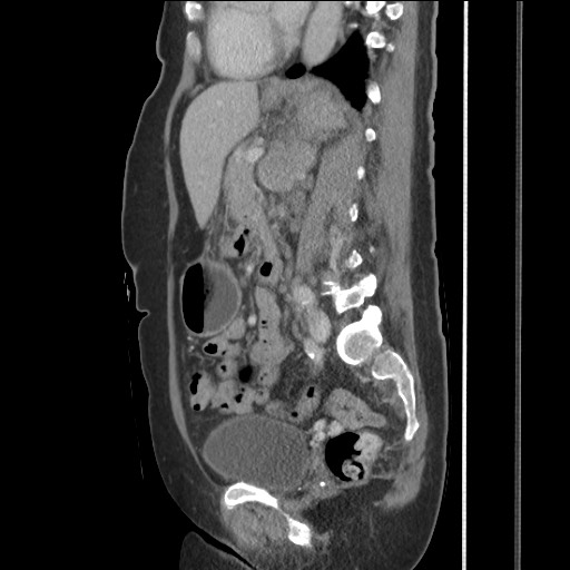 Bilateral adrenal granulocytic sarcomas (chloromas) (Radiopaedia 78375-91007 C 83).jpg