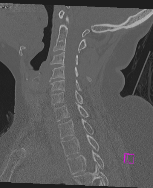 Bilateral atlanto-occipital assimilation (Radiopaedia 28350-28603 Sagittal bone window 36).jpg