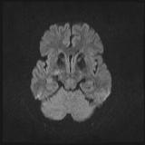 Bilateral basal ganglia and thalamic T1 hyperintensities (Radiopaedia 19764-19802 Axial DWI 27).jpg