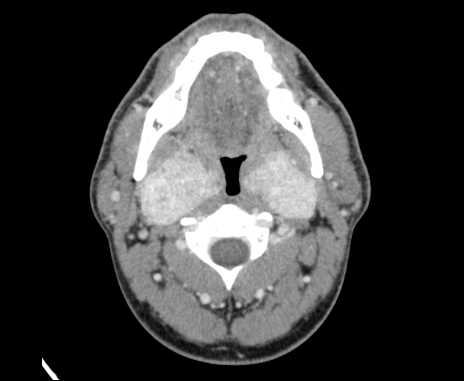 Bilateral carotid body tumors (Radiopaedia 61841-69870 Axial Post contrast 34).jpg