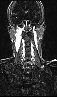 Bilateral carotid body tumors and right glomus jugulare tumor (Radiopaedia 20024-20060 MRA 110).jpg