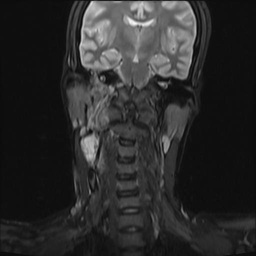 File:Bilateral carotid body tumors and right jugular paraganglioma (Radiopaedia 20024-20060 Coronal 29).jpg