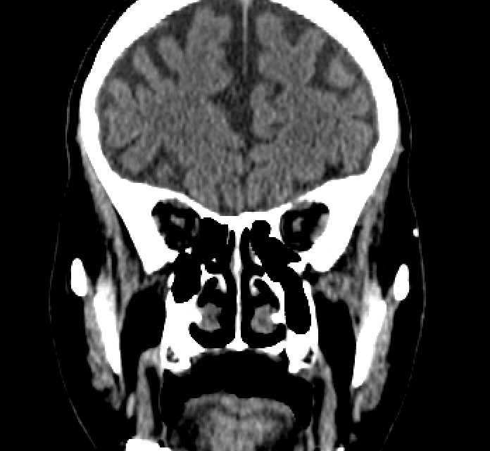 Bilateral ectopia lentis (Radiopaedia 89889-107013 Coronal non-contrast 85).jpg