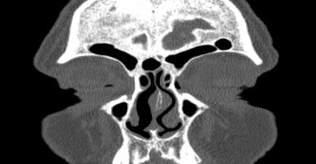 File:Bilateral ectopic infraorbital nerves (Radiopaedia 49006-54084 Coronal 65).png