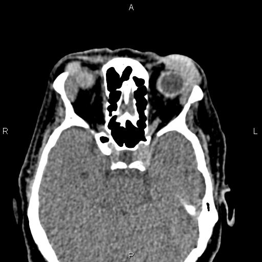 Bilateral enlargement of lacrimal glands - sarcoidosis (Radiopaedia 62627-70921 Axial non-contrast 52).jpg
