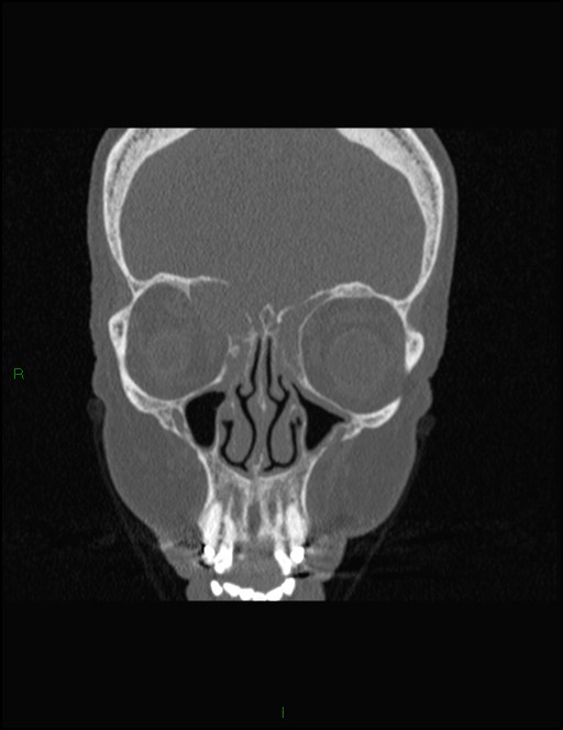 Bilateral frontal mucoceles (Radiopaedia 82352-96454 Coronal 112).jpg