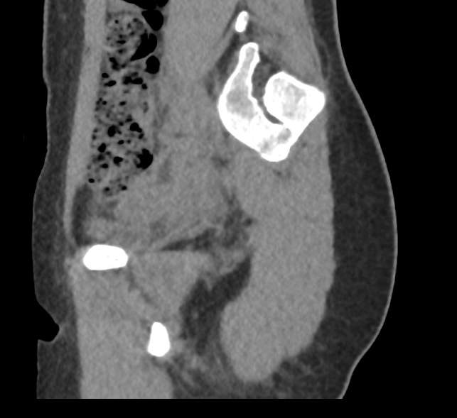 File:Bilateral mature cystic ovarian teratoma (Radiopaedia 88821-105592 D 10).jpg