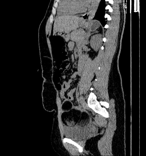 File:Bilateral ovarian dermoid (Radiopaedia 45714-49907 B 1).jpg