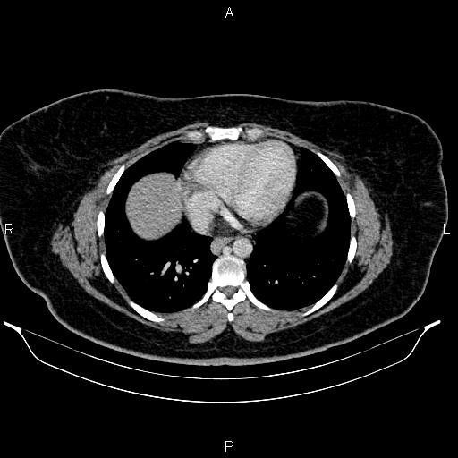 Bilateral ovarian dermoid cysts (Radiopaedia 85785-101603 A 9).jpg