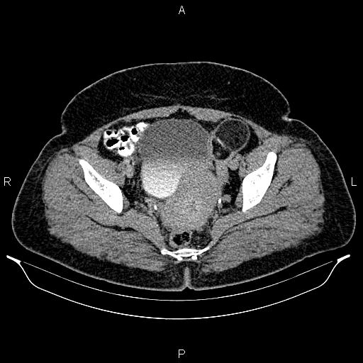 File:Bilateral ovarian dermoid cysts (Radiopaedia 85785-101603 Axial C+ delayed 73).jpg