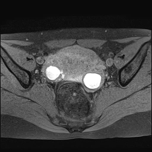 File:Bilateral ovarian endometriomas (Radiopaedia 87085-103347 Axial T1 fat sat 10).jpg