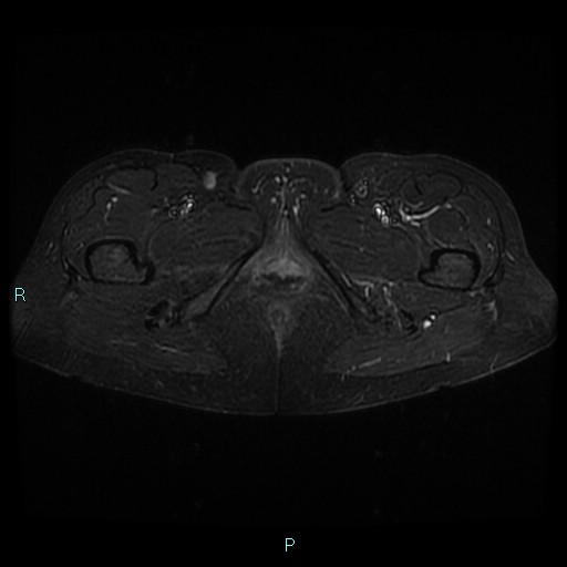 File:Bilateral ovarian fibroma (Radiopaedia 44568-48293 Axial STIR 31).jpg