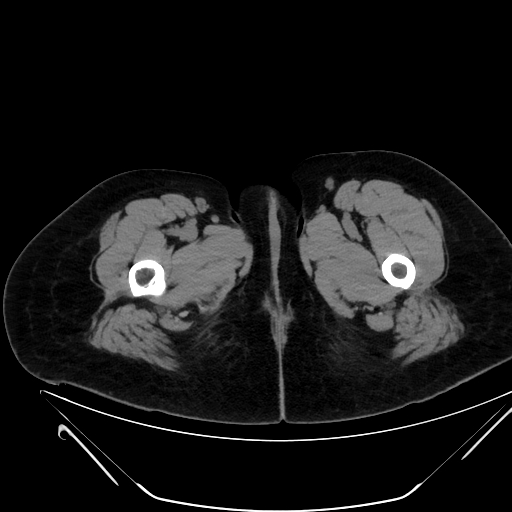 Bilateral ovarian mature cystic teratomas (Radiopaedia 79373-92457 Axial non-contrast 113).jpg