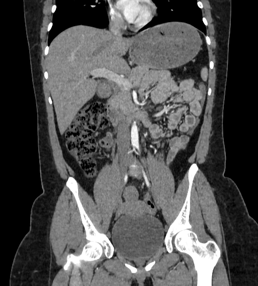 Bilateral ovarian mature cystic teratomas (Radiopaedia 79373-92457 B 29).jpg