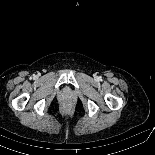 Bilateral ovarian serous cystadenocarcinoma (Radiopaedia 86062-101989 B 105).jpg