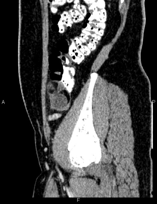 Bilateral ovarian teratoma (Radiopaedia 83131-97503 D 36).jpg
